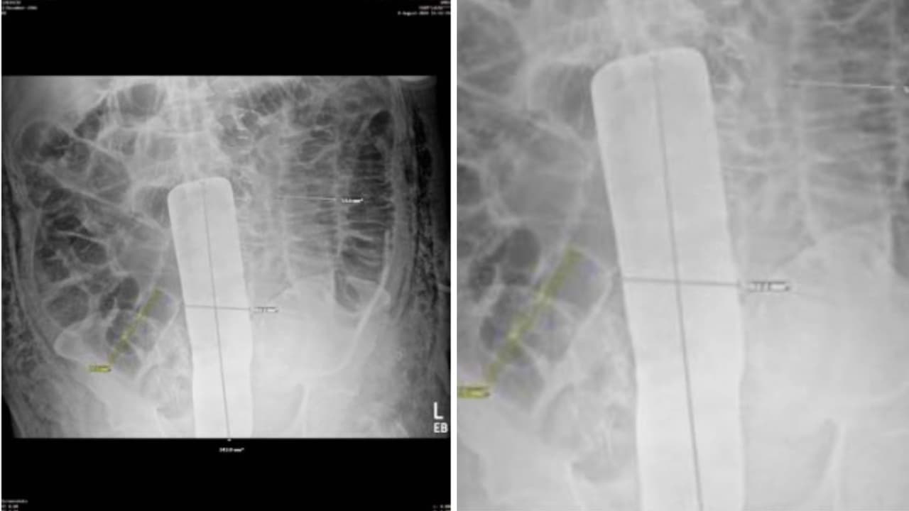 La radiografía de Genaro Nava revela cómo un instrumento quirúrgico de gran tamaño quedó olvidado dentro de su cuerpo tras una operación en Dallas.