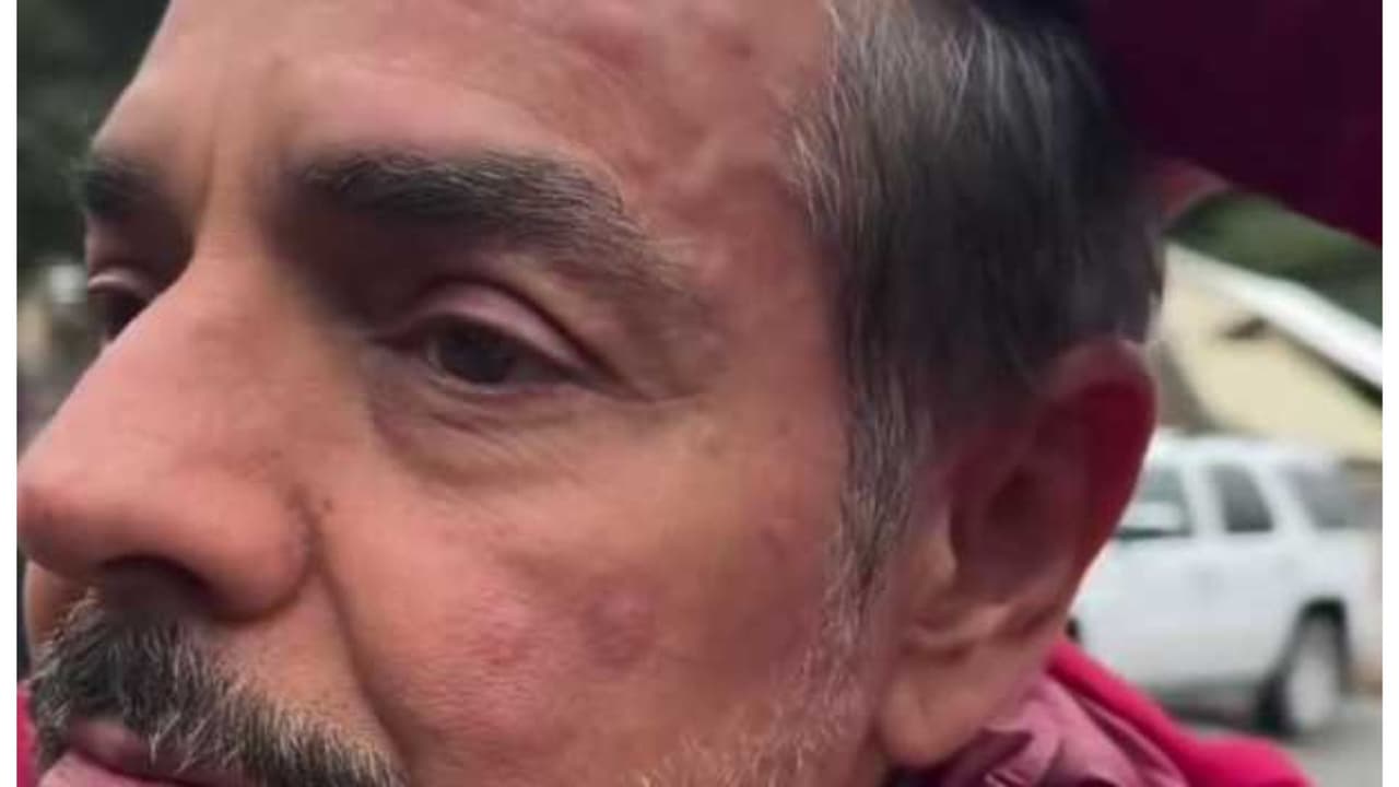 Eugenio Derbez apareció con el rostro hinchado por picaduras de mosco.