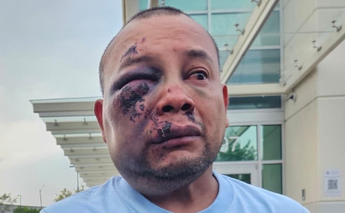 Inmigrante mexicano denuncia que agentes de ICE lo agredieron y acabó con el rostro desfigurado