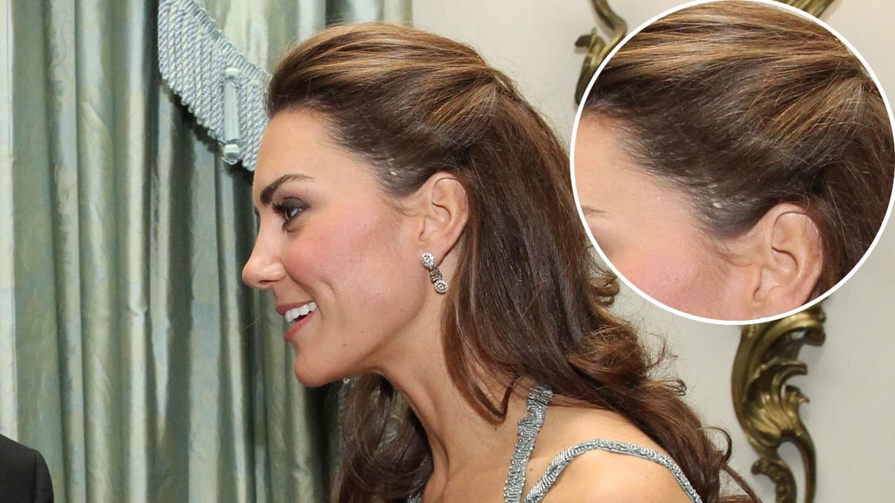 En ese entonces reconocieron que la cicatriz de Kate se debía a una cirugía que le fue practicada durante su infancia.