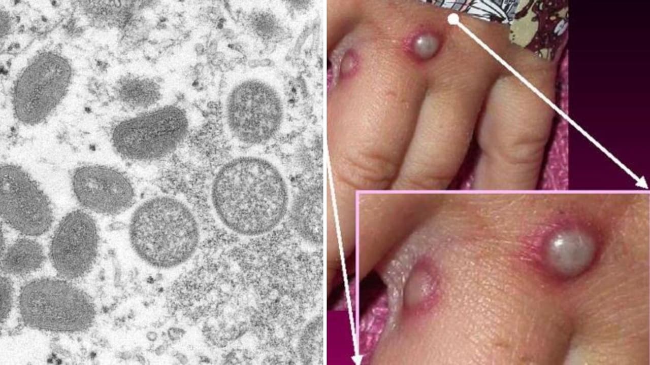 Detectan el primer caso sospechoso de viruela del mono en California