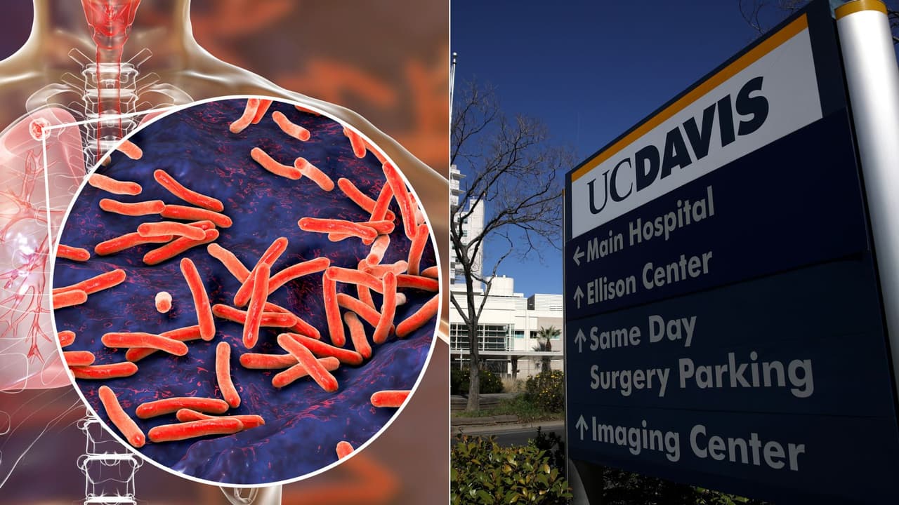 Alerta en UC Davis por un posible brote de tuberculosis: hay un caso confirmado en el campus
