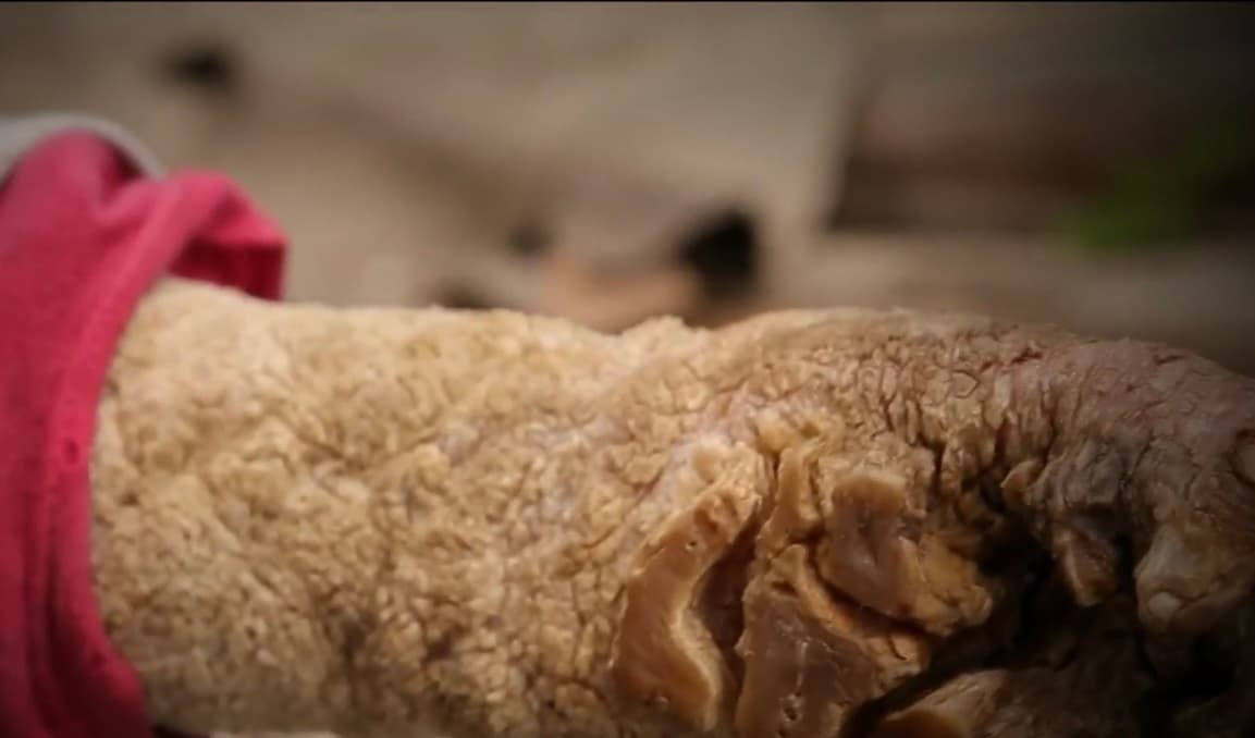 Cañas recuerda bien todo lo que ha sufrido desde los cinco años, en aquel entorno de pobreza en el que siempre creció, por culpa de la Epidermodisplasia Verruciforme que también le afecta sus pies, los cuales se están llenando de esas mismas cicatrices rocosas.
<br>