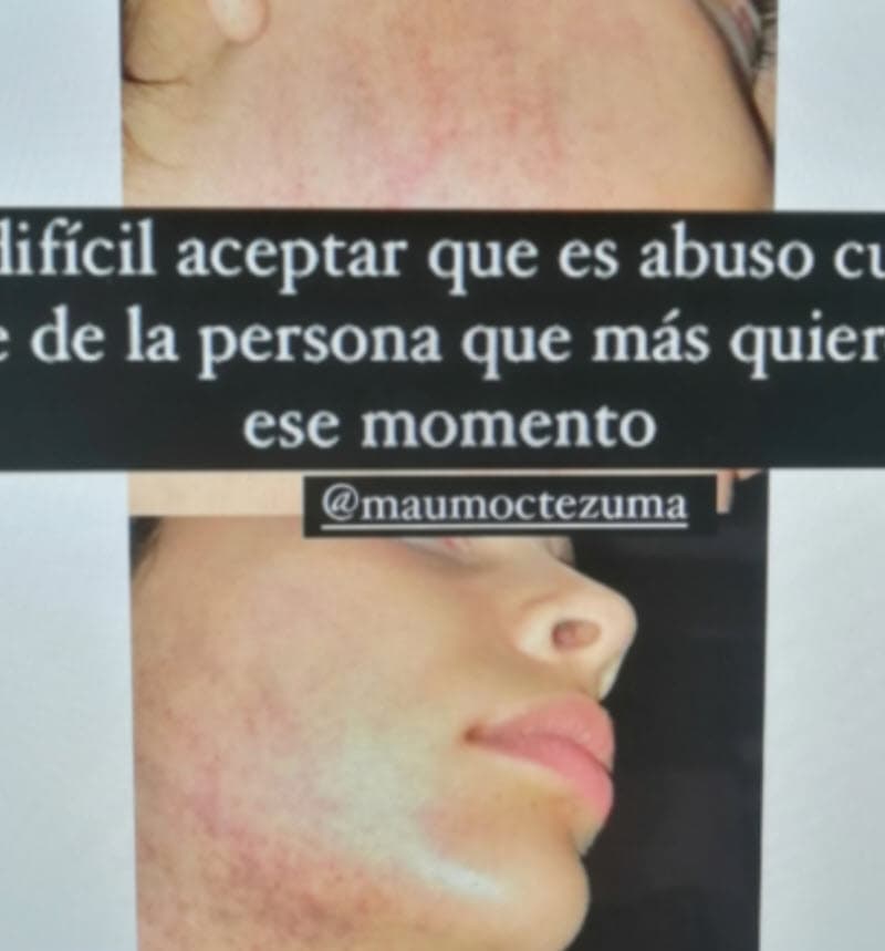 En otro, aparece la joven con lo que se presume podría ser la secuela de una agresión en el rostro: "
<b>Es difícil aceptar que es abuso</b> cuando viene de la persona que más quieres en ese momento", se menciona etiquetando al dj.
<br>