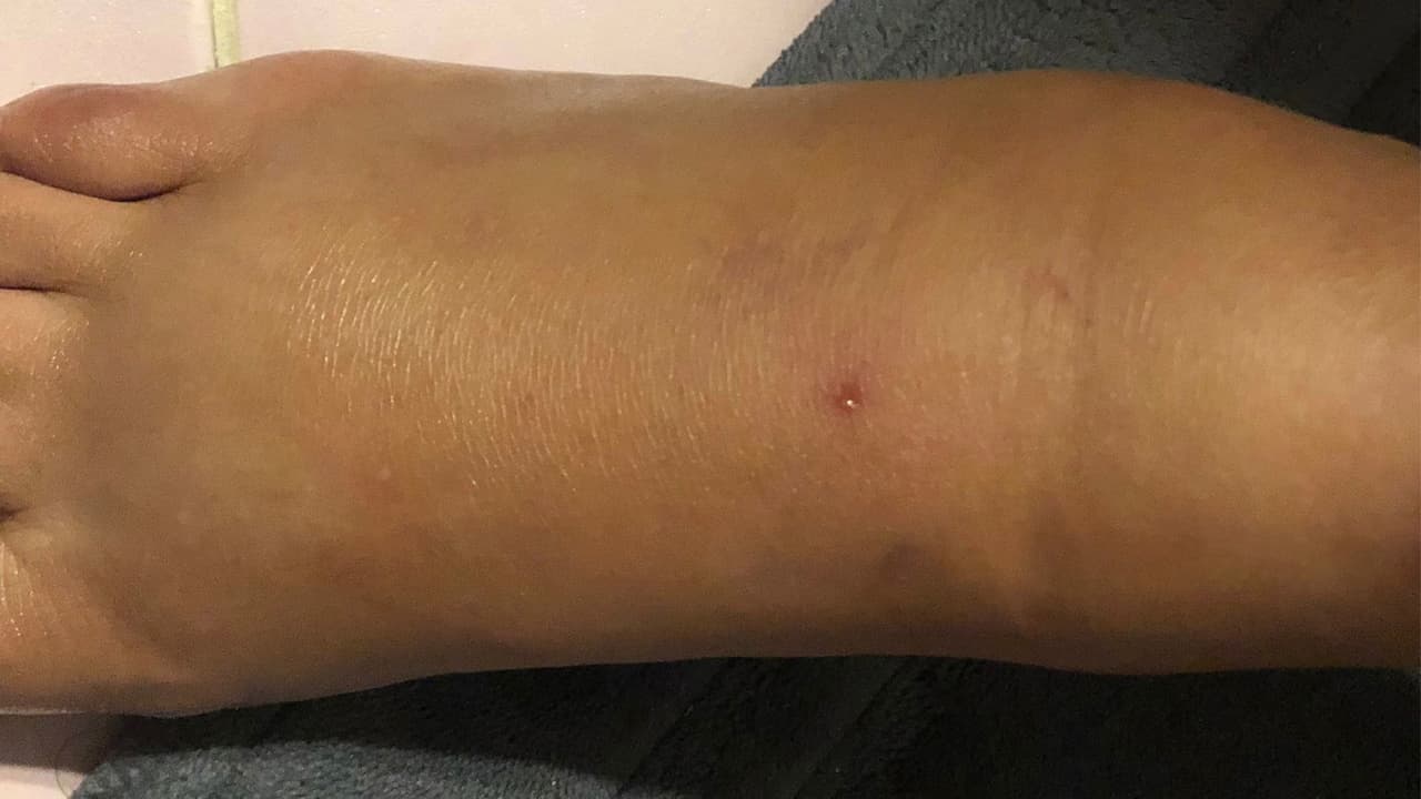 Al regresar a casa, la pareja comenzó a limpiar los pescados. Lou cuenta que al tener calor, se quitó sus zapatos y una de las jaibas (cangrejo azul) le cayó en su pie. El contacto fue mínimo pero le hizo la pequeña picada que se muestra en la foto.