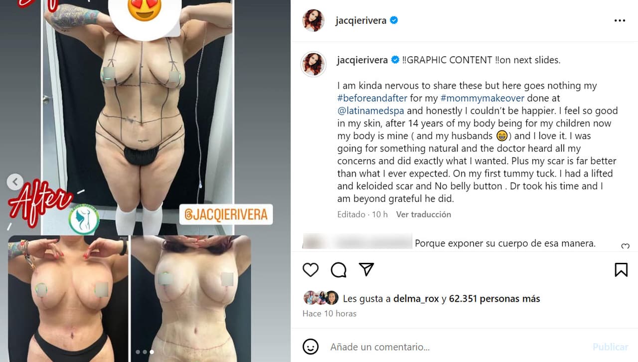 Este es el 'antes y después' definitivo del 'mommy makeover' de Jacqie Rivera.