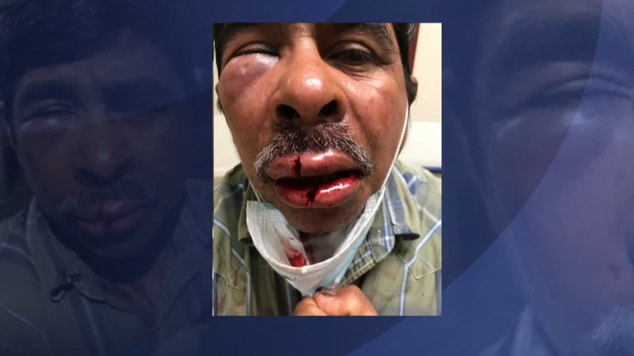 Marcelo Labra, un inmigrante de origen mexicano que reside en el área de Kendale Lakes, en el suroeste de Miami-Dade, está denunciando un brutal ataque en su contra, el cual posiblemente estuvo motivado por el odio.
<br>