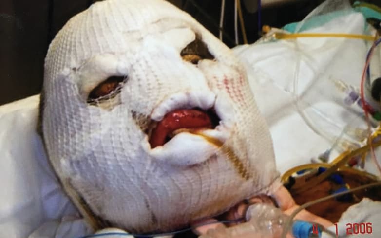 Kechi Okwuchi estuvo hospitalizada siete meses en áfrica del Sur tras el accidente aéreo que sufrió.