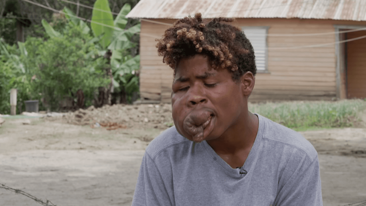 Ayuda de Impacto: Este joven tiene un tumor en su rostro que cada día es más grande