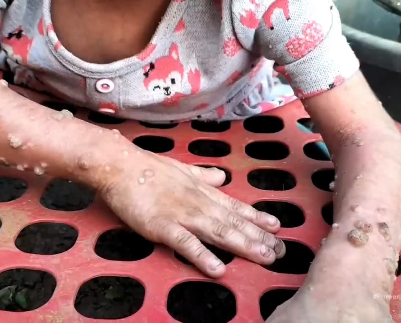 Por si fuera poco, Astrid Maribel y Saida, de 9 y 4 años, viven en Guatemala, sumidas en un contexto de extrema pobreza junto a sus padres, todos diagnosticados con un cuadro severo de desnutrición.
<br>