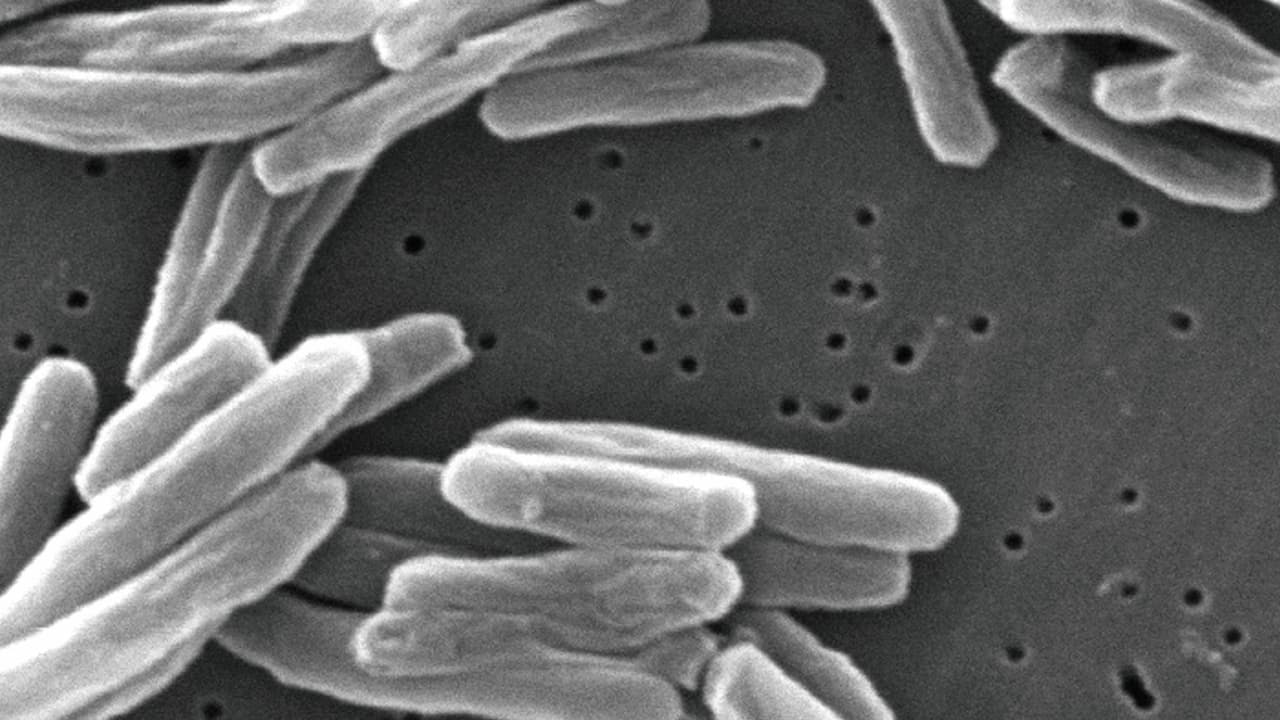 Emergencia sanitaria por brote de tuberculosis en un hotel de Long Beach en California: un muerto y 14 infectados