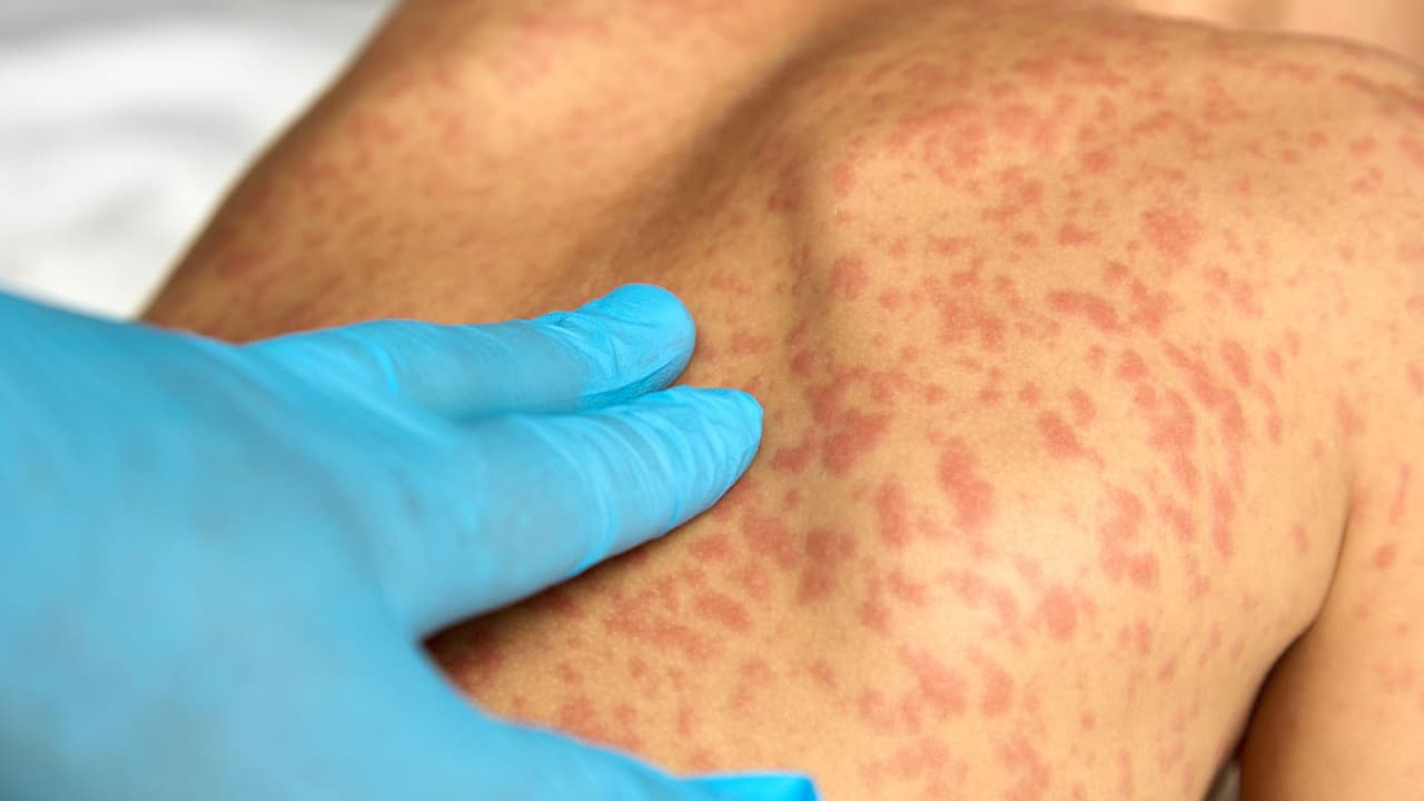 ¿Cuáles son las diferencias entre la rubéola y el sarampión? Te explicamos cómo identificar los síntomas