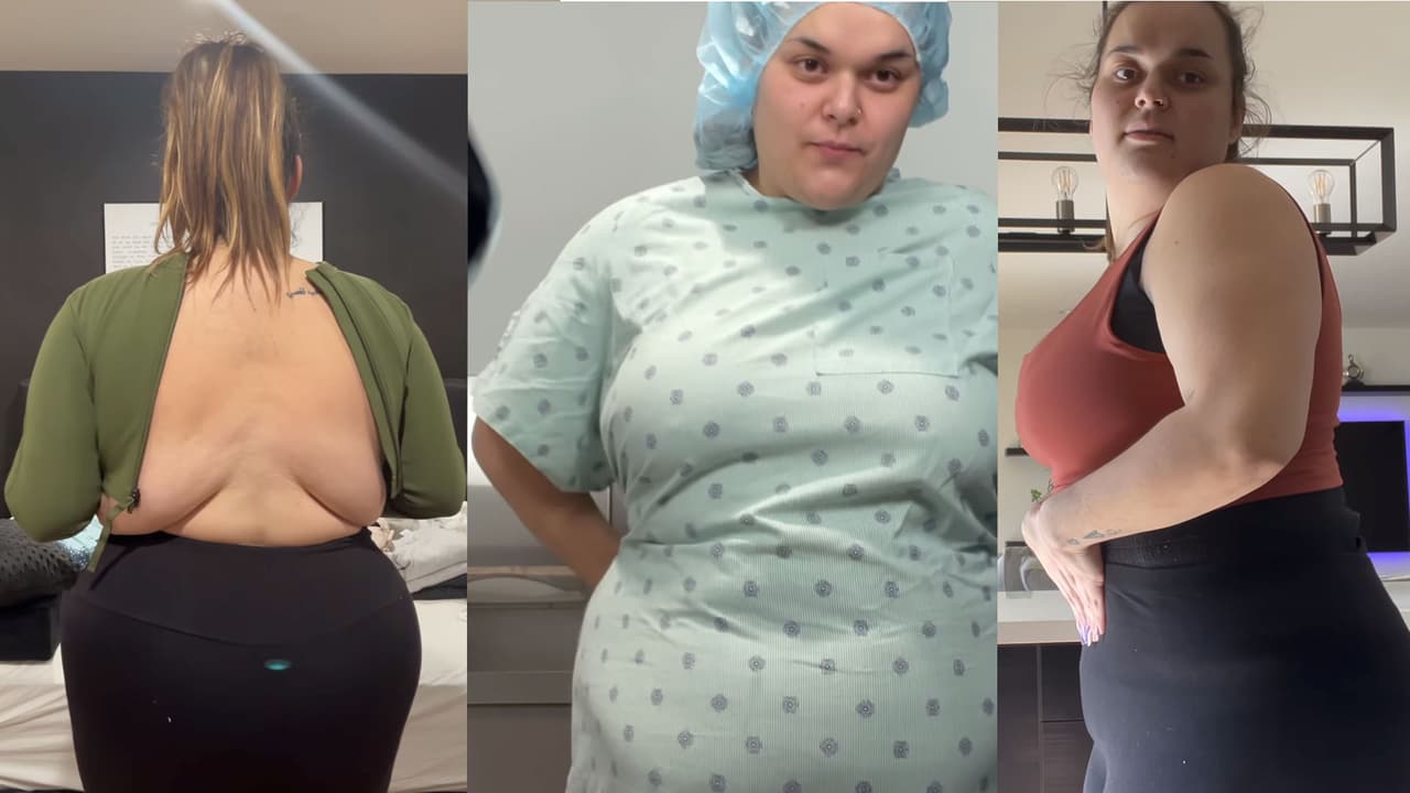 Una de las cirugías eran para quitarle el exceso de piel de la espalda y moldear sus glúteos con aspecto brasileño. La segunda para subirse el pecho y la última para disminuir el estómago.