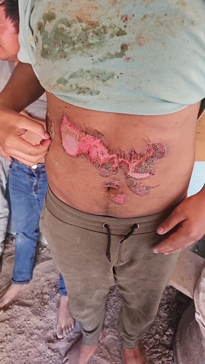 Heridas mostradas por uno de los inmigrantes a las autoridades.