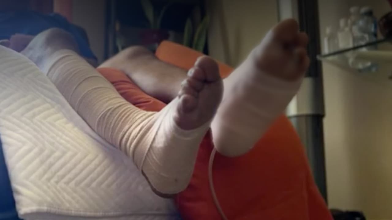 Hombre sufrió una amputación en el pie por una presunta negligencia médica en Sacramento