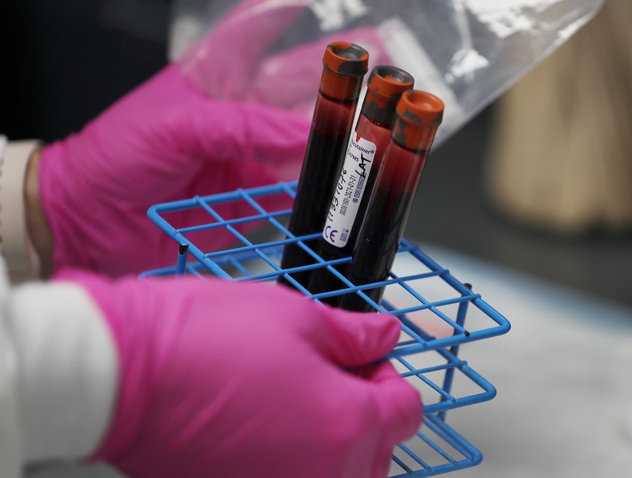 Muestras de sangre de un paciente durante un estudio de vacunación covid-19 en los Centros de Investigación de América en Hollywood, Florida.
<br>