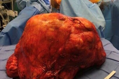 El liposarcoma de Hernández era el más grande que su médico haya visto. Pesaba 77 libras cuando, por lo general, no pasan de 30.