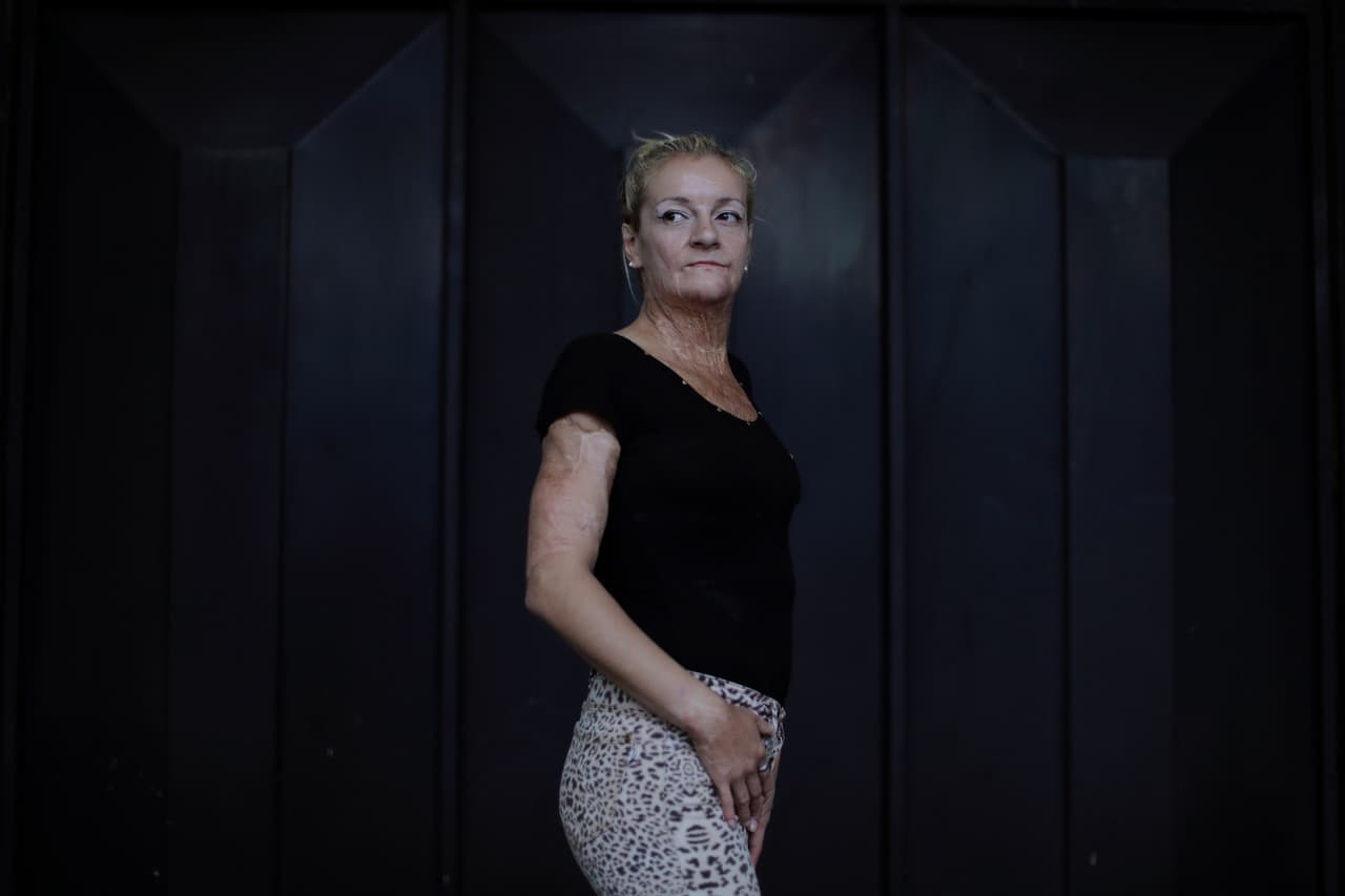 El ex marido de Romina Olivera le prendió fuego el 24 de marzo de 2012. Pasó seis meses en el hospital. Su agresor fue arrestado y condenado a ocho años de prisión por intento de asesinato. Ella dice que tiene problemas para conseguir un trabajo después del ataque que dejó el 60 por ciento de su cuerpo quemado. "Me siento más fuerte, pero arruinó mi vida".