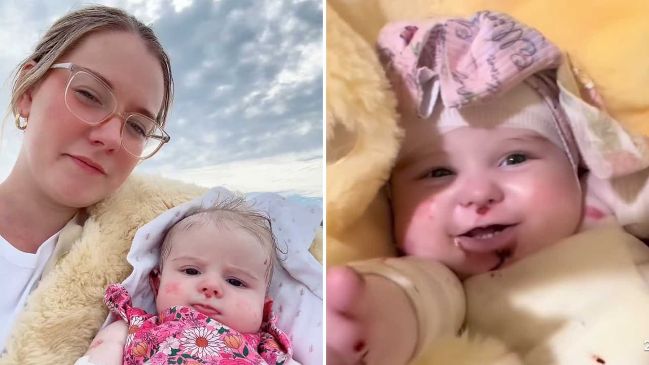 Muere bebé de 10 meses de reconocida ‘influencer’ debido a rara enfermedad de la piel