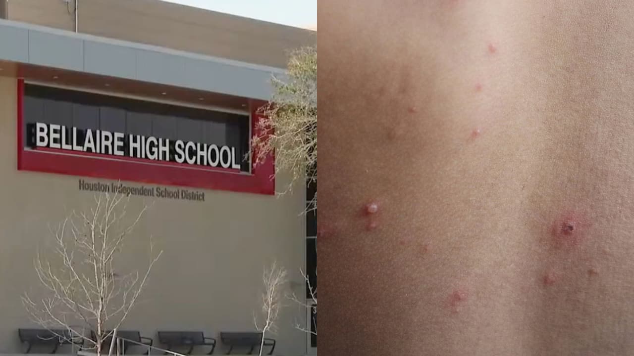 Preocupación en Bellaire High School por casos de estafilococo: ¿Qué es y cómo se contagia un estudiante?