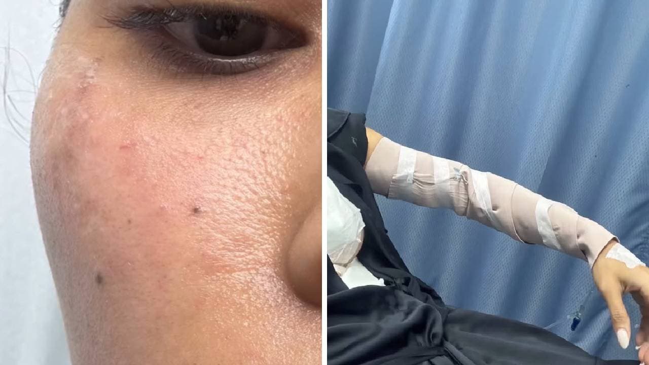 Debbie Aflalo muesra sus quemaduras.