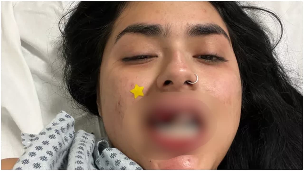 Joven hispana pierde dientes tras asalto y golpiza a plena luz del día en Pilsen