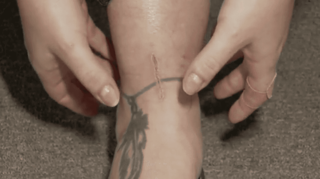 La bacteria había comenzado en mi tobillo y escaló hasta mi muslo en tan solo 24 horas. Comencé a sentir un fuerte escozor alrededor de la cortada. Y después comenzó a hincharse casi inmediatamente”, dijo Martinez.