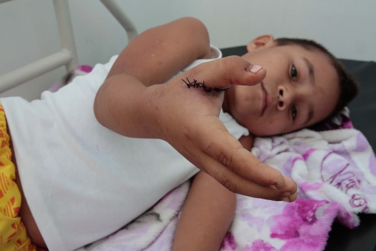 Este niño del estado Apure en Venezuela llegó luego cortarse la mano con una teja. Su familia se mudó a Colombia hace poco.