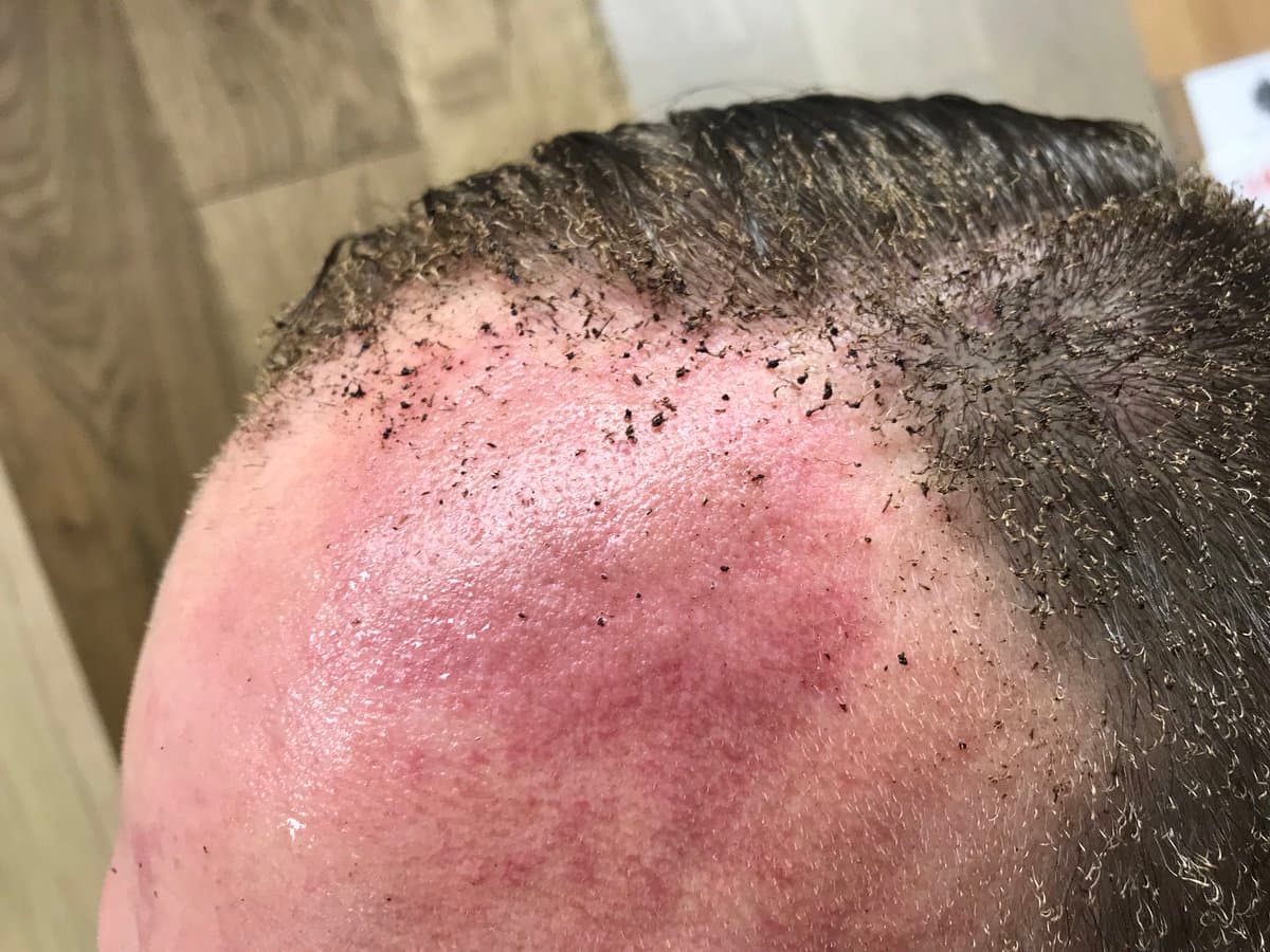 Peter Crowley publicó en su cuenta de Twitter una fotografía de su cabeza quemada por la "bola de fuego" dentro del vagón del metro en que viajaba.