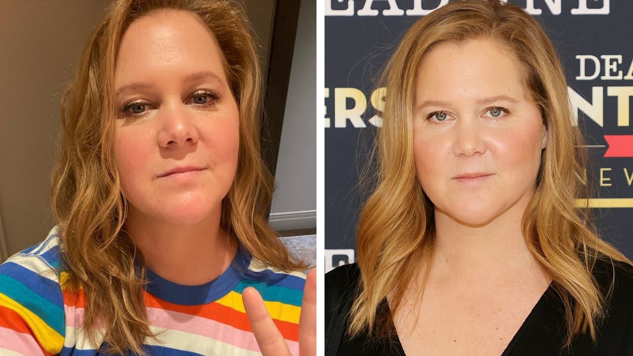 Amy Schumer se quitó los rellenos faciales y compartió una foto del proceso