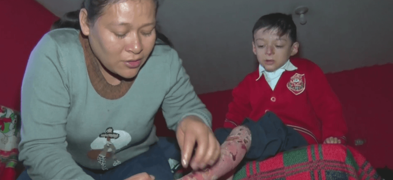“Nos duele la piel”: el clamor de estos dos hermanos que padecen de una rara enfermedad