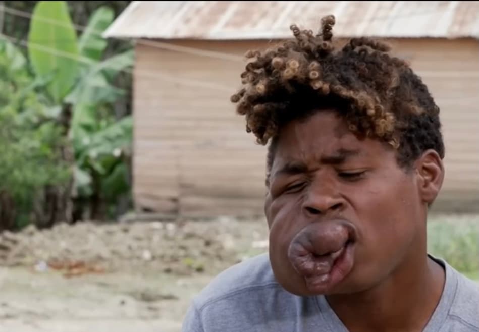 Cuando Freddy Montero nació toda su familia se dio cuenta que tenía una pequeña mancha en su labio superior. A los pocos meses se dieron cuenta que ese punto diminuto en su boca ya había crecido y nadie se imaginaba que no pararía de crecer,
<b>dejándole una masa gigantesca en el rostro del joven. </b>
<br>