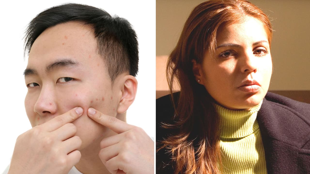 Descubrió la infidelidad de su novio gracias a una espinilla: así se dio cuenta