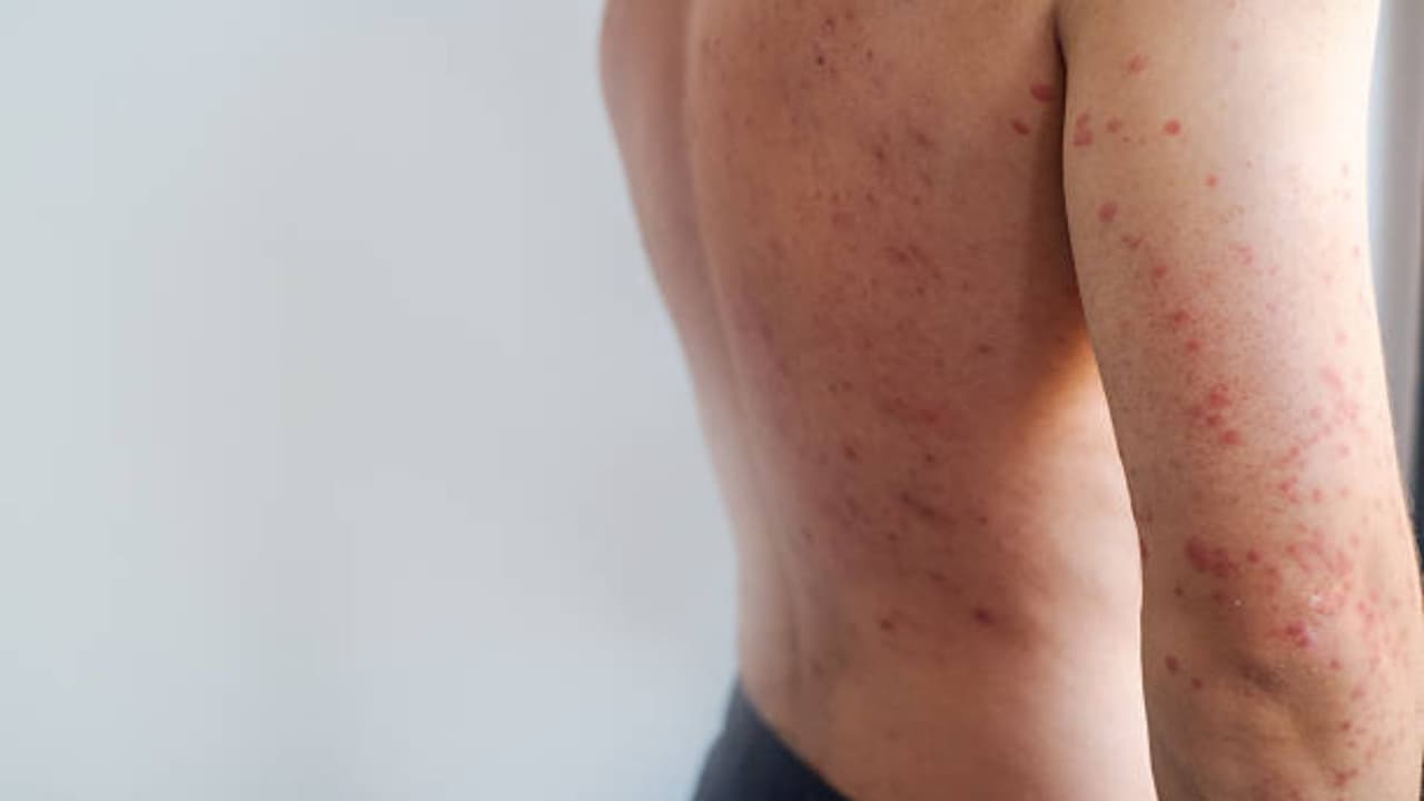 Autoridades reportan primer caso de sarampión de 2026 en Florida Central