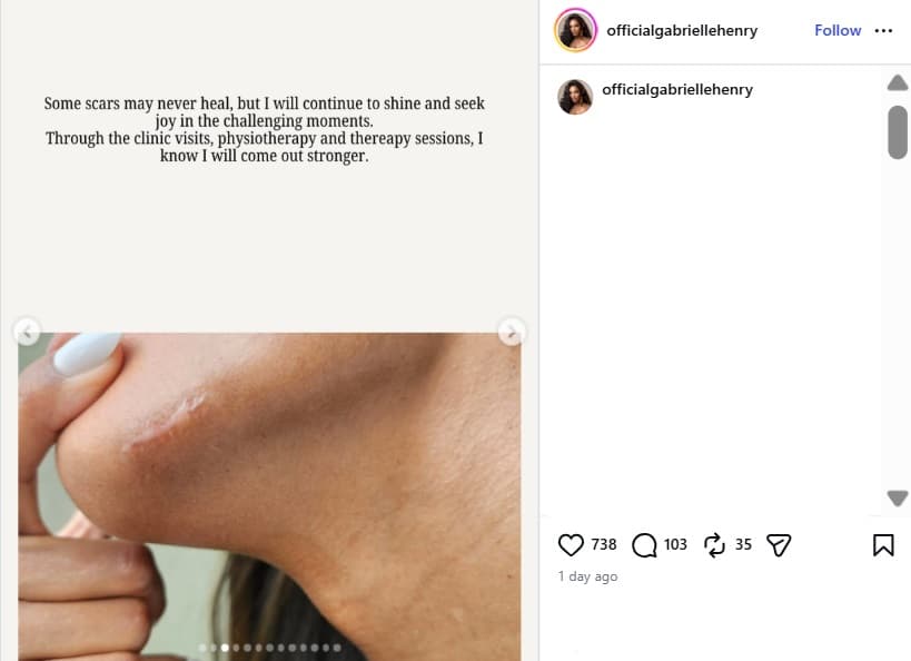 Gabrielle Henry compartió imágenes de las cicatrices que le quedaron tras su caída en Miss Universe 2025.