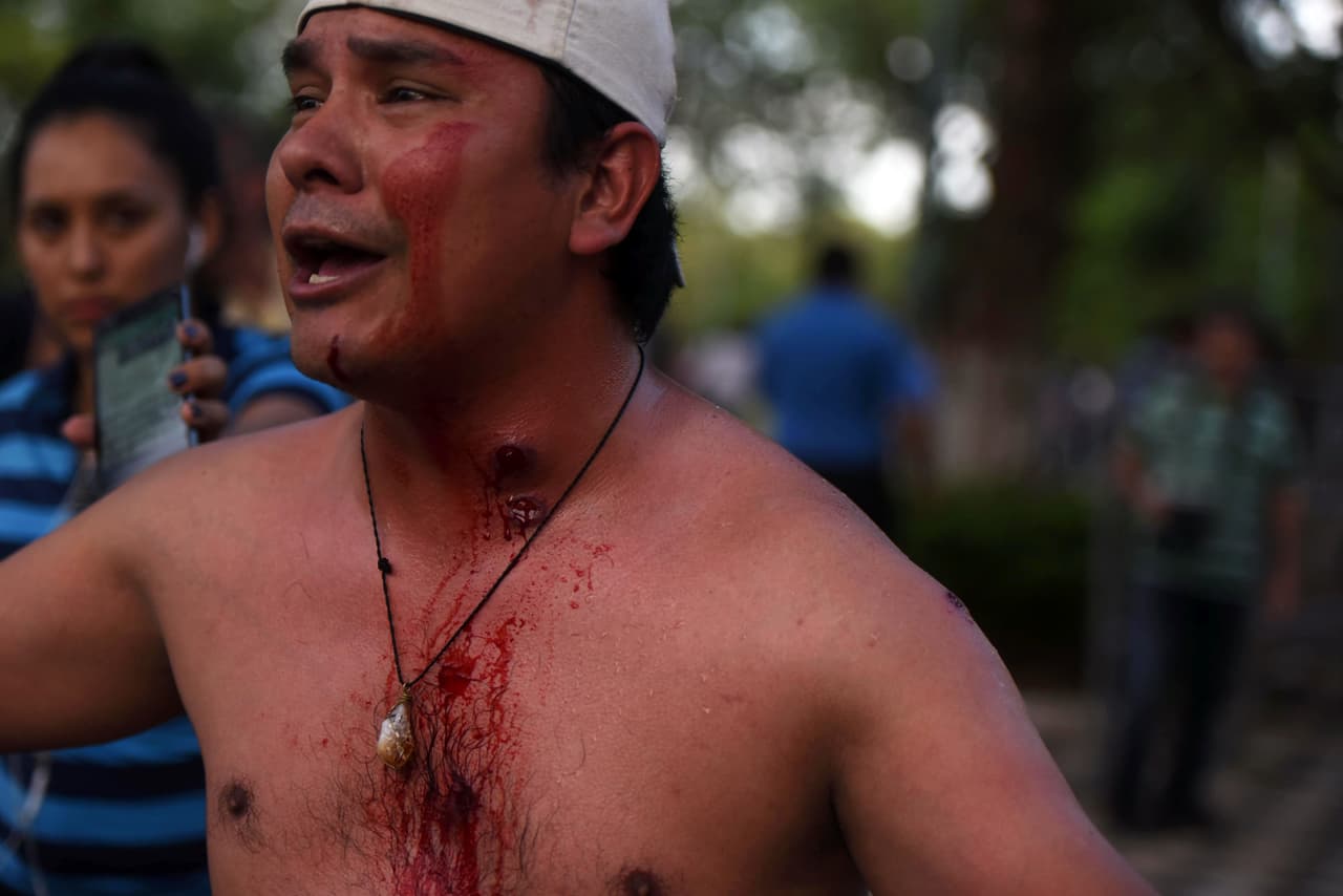 La decisión desató incidentes que dejaron unos 30 heridos, entre ellos legisladores opositores y activistas, según reportó el departamento de Bomberos. En la imagen se observa a un manifestante con una herida de bala de goma en el cuello.