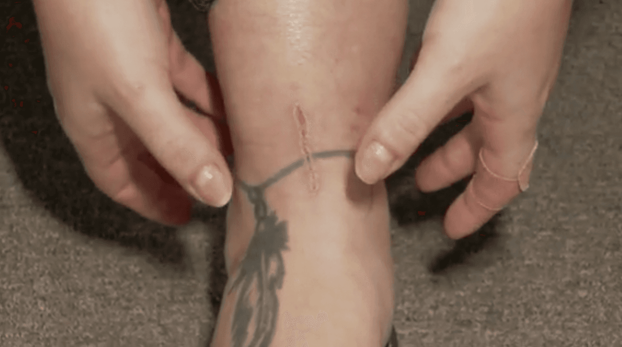 “Lo más asustador fue ver la cara de preocupación de los doctores. La bactería había comenzado en mi tobillo y escaló hasta mi muslo en tan solo 24 horas. Eso era su mayor preocupación”, dijo Martinez.