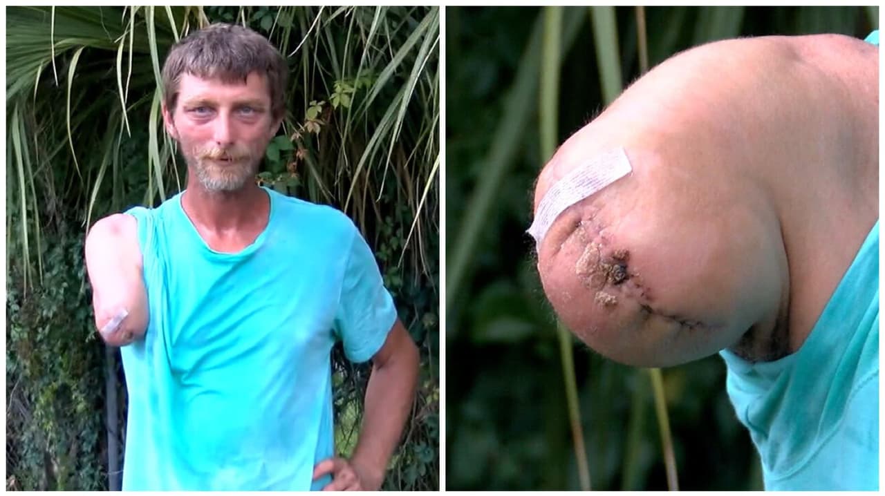 “Tiene suerte de estar vivo”: sale del hospital el hombre a quien un caimán le arrancó el brazo