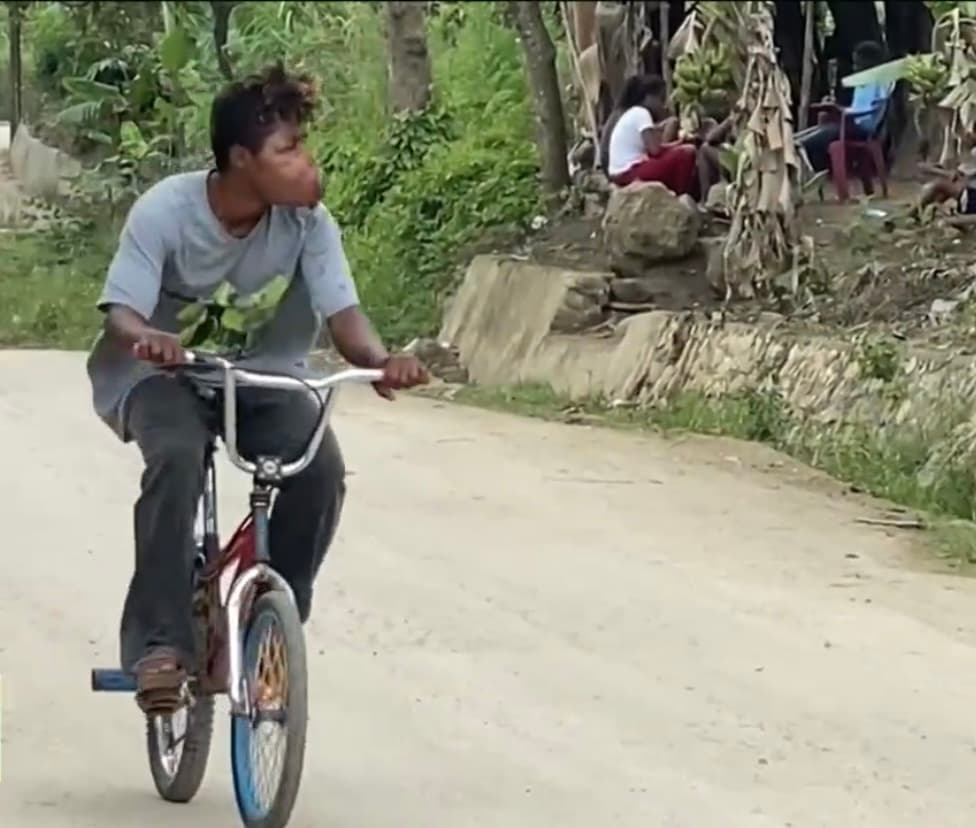 Oriundo del municipio de El Cercado, en la provincia
<a href="https://www.univision.com/temas/republica-dominicana">dominicana </a>de San Juan, Freddy dice que a sus 19 años se ha acostumbrado a vivir con esa enfermedad poco conocida que le diagnosticaron llamada Hemangioma Cavernoso,
<b>un tumor no cancerígeno causado por el crecimiento anormal de los vasos sanguíneos. </b>
<br>