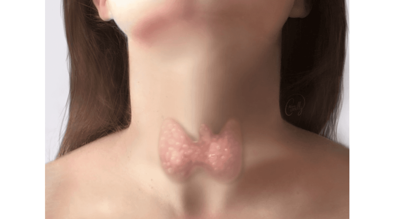 Nueva prueba de Universidad de Texas detecta cáncer de tiroides en horas