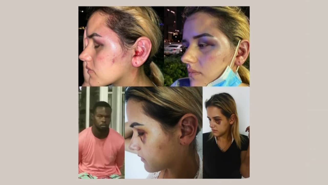 Andrea tiene hematomas en los brazos, una costilla rota, durante varios días no pudo abrir la mandíbula y la espalda le dolía tanto que no podía pararse de la cama.
<br>