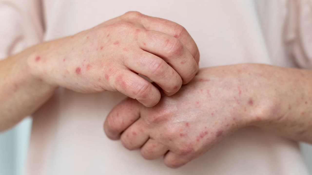 Brote de sarampión en Pensilvania supera los 900 casos.