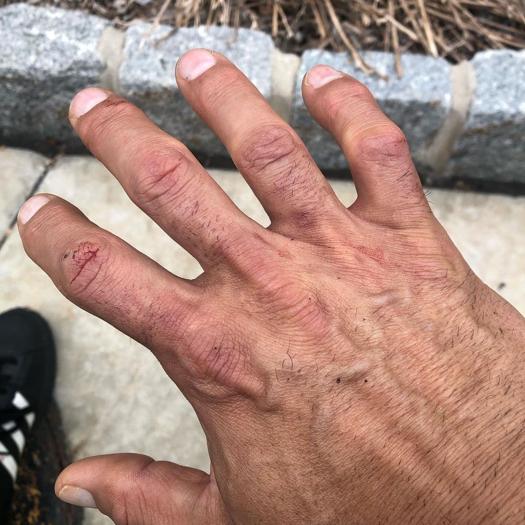 “Dos dedos destrozados, uno dislocado y otro jodido. Cicatrices de batalla por arrancar la puerta de un auto desde la bisagra. Valió la pena para ayudar a un ser humano que lo necesitaba”, agregó.