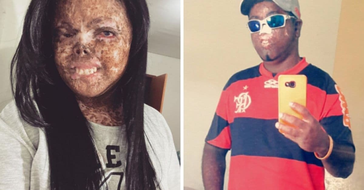 Hermanos tienen cáncer en la piel y son juzgados por su apariencia: dieron una gran lección