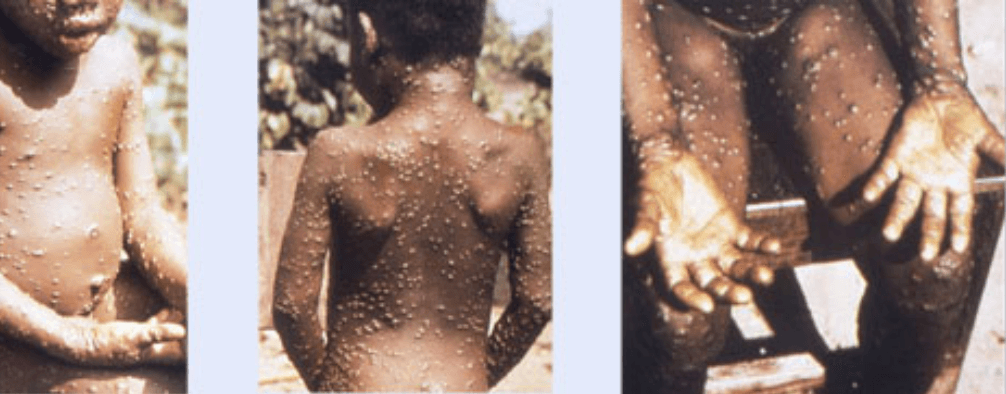 Si una persona estuvo en contacto cercano con alguien contagiado, debe estar atento a los síntomas que podría presentar y ver si le salen ampollas en la piel.