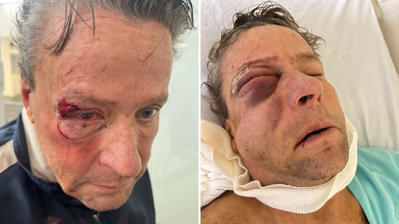 Alfredo Adame revela que le colocaron cuatro placas de titanio en el rostro