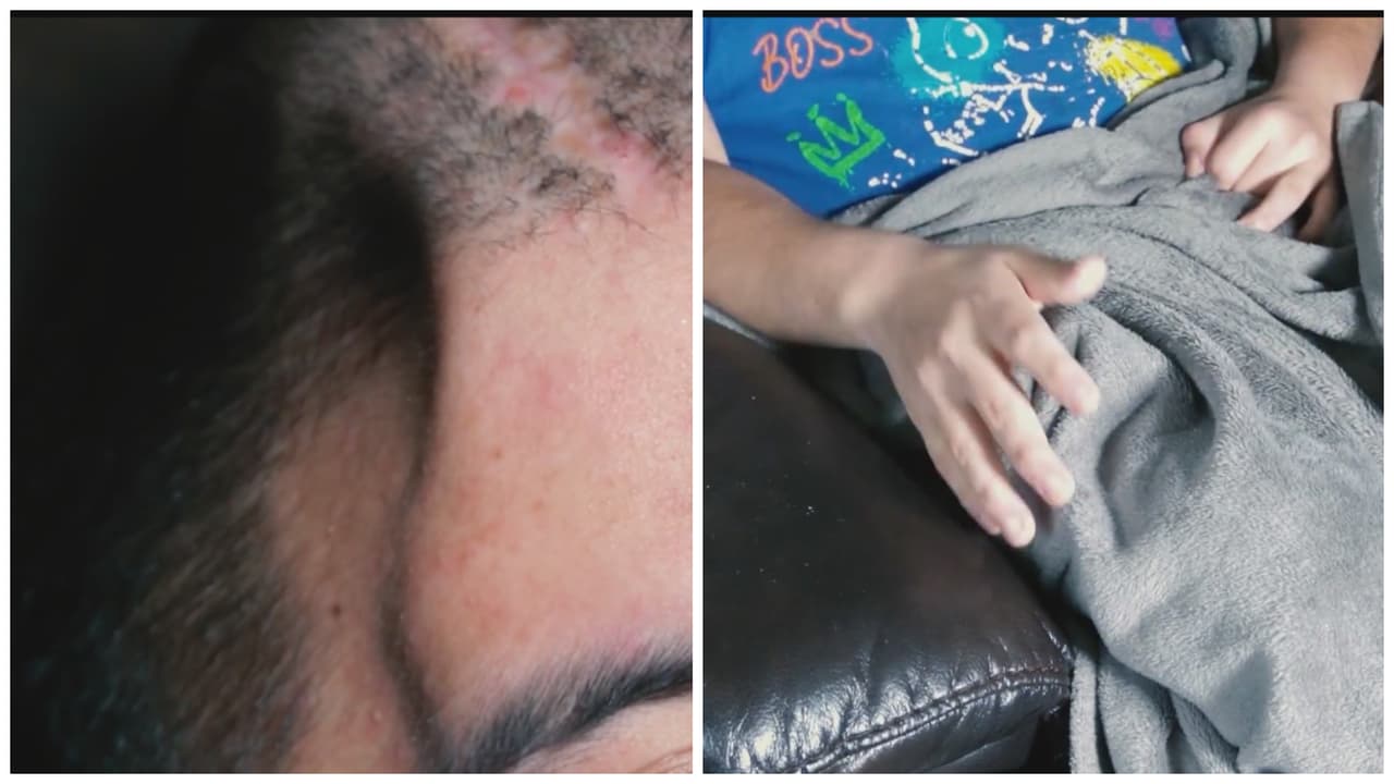 Salvadoreño logró sobrevivir con medio cráneo y tras una década en EEUU quiere volver a su país