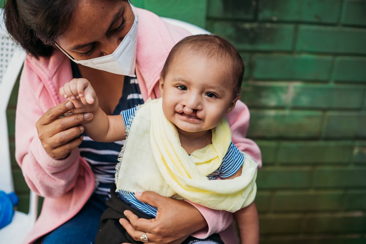 Uno de cada 700 niños nace con labio leporino o paladar hendido, lo que afecta su capacidad para comunicarse, recibir una alimentación adecuada y puede generar discriminación en muchas partes del mundo.