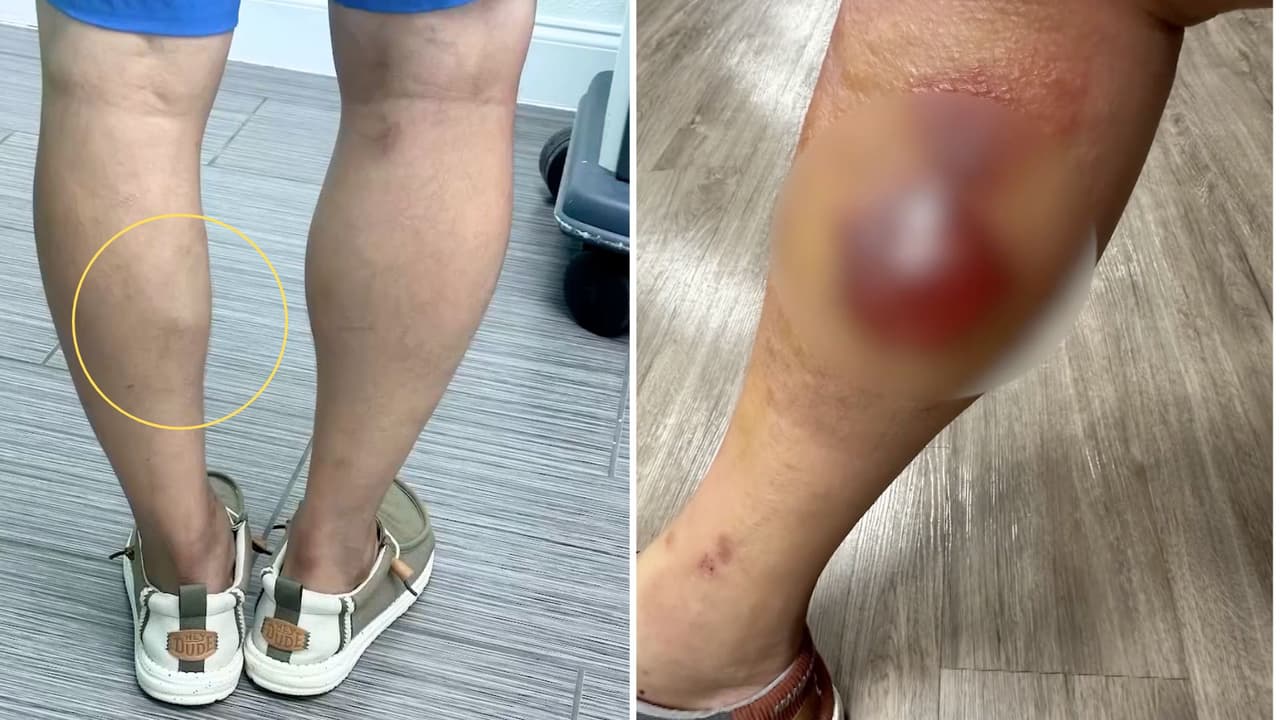 Lo que comenzó como una aparente picadura terminó convirtiéndose en una infección grave.