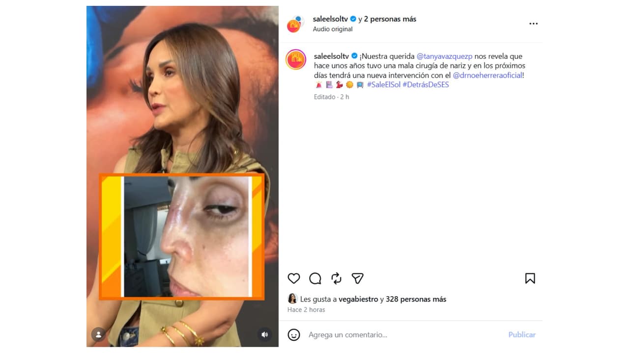 Tanya Vázquez muestra en 'Sale el Sol' como quedó su nariz tras una mala praxis.